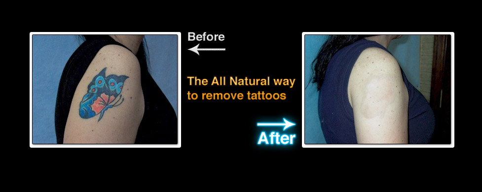 Remove Tattoo